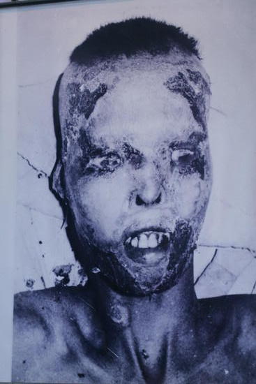 Victim of white phosphorus bomb